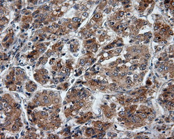 PTPRE / PTP Epsilon Antibody - Immunohistochemical staining of paraffin-embedded Carcinoma of liver tissue using anti-PTPRE mouse monoclonal antibody. (Dilution 1:50).