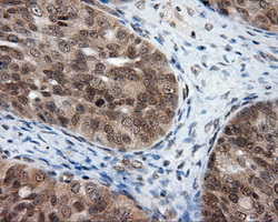PTPRE / PTP Epsilon Antibody - Immunohistochemical staining of paraffin-embedded Adenocarcinoma of ovary tissue using anti-PTPRE mouse monoclonal antibody. (Dilution 1:50).