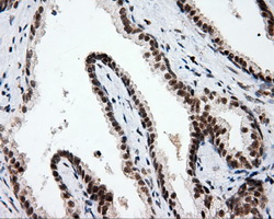 PTPRE / PTP Epsilon Antibody - Immunohistochemical staining of paraffin-embedded Carcinoma of prostate tissue using anti-PTPRE mouse monoclonal antibody. (Dilution 1:50).