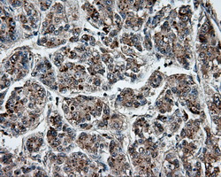 PTPRE / PTP Epsilon Antibody - Immunohistochemical staining of paraffin-embedded Carcinoma of liver tissue using anti-PTPRE mouse monoclonal antibody. (Dilution 1:50).