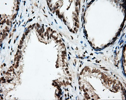 PTPRE / PTP Epsilon Antibody - Immunohistochemical staining of paraffin-embedded Carcinoma of prostate tissue using anti-PTPRE mouse monoclonal antibody. (Dilution 1:50).