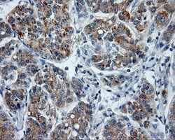 PTPRE / PTP Epsilon Antibody - IHC of paraffin-embedded Carcinoma of liver tissue using anti-PTPRE mouse monoclonal antibody. (Dilution 1:50).