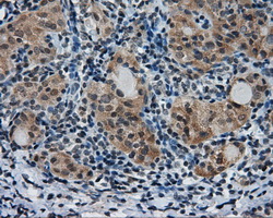 PTPRE / PTP Epsilon Antibody - IHC of paraffin-embedded Carcinoma of thyroid tissue using anti-PTPRE mouse monoclonal antibody. (Dilution 1:50).
