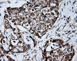 PTPRE / PTP Epsilon Antibody - IHC of paraffin-embedded Adenocarcinoma of breast tissue using anti-PTPRE mouse monoclonal antibody. (Dilution 1:50).