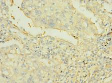 PTPRJ / CD148 Antibody - Immunohistochemistry of paraffin-embedded human lung cancer at dilution 1:100