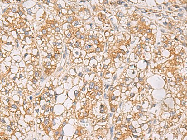 PTPRN / IA-2 Antibody - Immunohistochemistry of paraffin-embedded Human liver cancer tissue  using PTPRN Polyclonal Antibody at dilution of 1:55(×200)