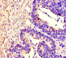 PTPRS Antibody - Immunohistochemistry of paraffin-embedded human ovarian cancer at dilution of 1:100
