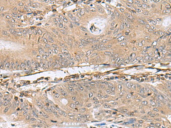 PTPRS Antibody - Immunohistochemistry of paraffin-embedded Human colorectal cancer tissue  using PTPRS Polyclonal Antibody at dilution of 1:110(×200)