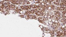 PTPRU Antibody - 1:100 staining human liver carcinoma tissues by IHC-P. The sample was formaldehyde fixed and a heat mediated antigen retrieval step in citrate buffer was performed. The sample was then blocked and incubated with the antibody for 1.5 hours at 22°C. An HRP conjugated goat anti-rabbit antibody was used as the secondary.