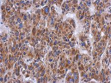 PTS Antibody - IHC of paraffin-embedded Hepatoma using PTS antibody at 1:500 dilution.