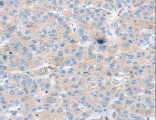 PTX3 / Pentraxin 3 Antibody - Immunohistochemistry of paraffin-embedded Human liver cancer using PTX3 Polyclonal Antibody at dilution of 1:25.