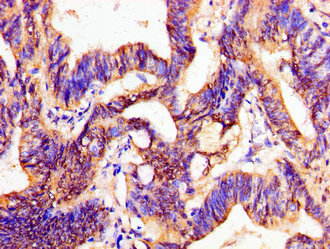 PTX3 / Pentraxin 3 Antibody - Immunohistochemistry image of paraffin-embedded human colon cancer at a dilution of 1:100