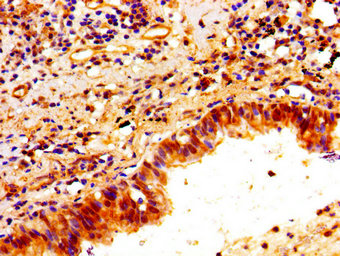 PTX3 / Pentraxin 3 Antibody - Immunohistochemistry image of paraffin-embedded human lung cancer at a dilution of 1:100
