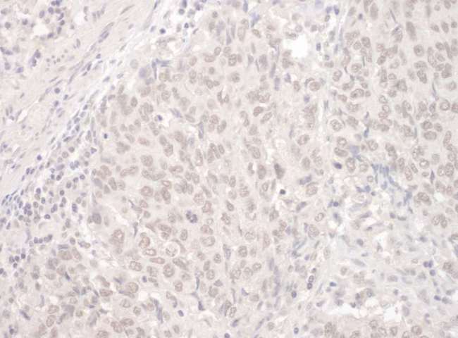 PUF60 Antibody - Detection of Human PUF60 by Immunohistochemistry. Sample: FFPE section of human lung carcinoma. Antibody: Affinity purified rabbit anti-PUF60 used at a dilution of 1:200 (1 ug/mg).