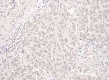 PUF60 Antibody - Detection of Human PUF60 by Immunohistochemistry. Sample: FFPE section of human lung carcinoma. Antibody: Affinity purified rabbit anti-PUF60 used at a dilution of 1:200 (1 ug/mg).