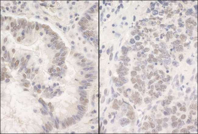 PUF60 Antibody - Detection of Human and Mouse PUF60 by Immunohistochemistry. Sample: FFPE section of human colon carcinoma (left) and mouse teratoma (right). Antibody: Affinity purified rabbit anti-PUF60 used at a dilution of 1:200 (1 ug/mg).