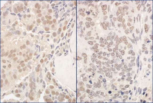 PUF60 Antibody - Detection of Human and Mouse PUF60 by Immunohistochemistry. Sample: FFPE section of human prostate carcinoma (left) and mouse teratoma (right). Antibody: Affinity purified rabbit anti-PUF60 used at a dilution of 1:200 (1 ug/mg).