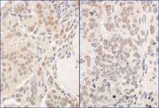PUF60 Antibody - Detection of Human and Mouse PUF60 by Immunohistochemistry. Sample: FFPE section of human prostate carcinoma (left) and mouse teratoma (right). Antibody: Affinity purified rabbit anti-PUF60 used at a dilution of 1:200 (1 ug/mg).