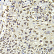 PUF60 Antibody - Immunohistochemistry of paraffin-embedded human well-differentiated squamous skin carcinoma tissue.