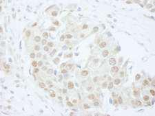PUS1 Antibody - Detection of Human PUS1 by Immunohistochemistry. Sample: FFPE section of human breast carcinoma. Antibody: Affinity purified rabbit anti-PUS1 used at a dilution of 1:250.