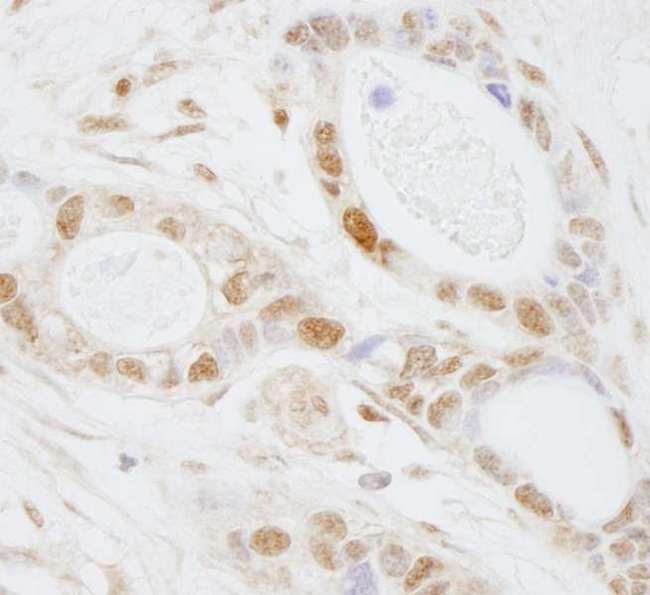 PUS1 Antibody - Detection of Human PUS1 by Immunohistochemistry. Sample: FFPE section of human ovarian tumor. Antibody: Affinity purified rabbit anti-PUS1 used at a dilution of 1:250.