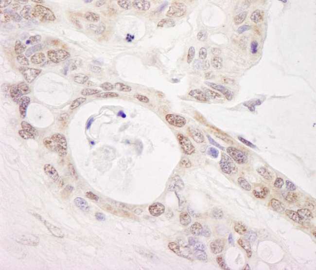 PUS1 Antibody - Detection of Human PUS1 by Immunohistochemistry. Sample: FFPE section of human ovarian carcinoma. Antibody: Affinity purified rabbit anti-PUS1 used at a dilution of 1:1000 (0.2 ug/ml). Detection: DAB.