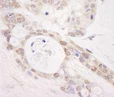PUS1 Antibody - Detection of Human PUS1 by Immunohistochemistry. Sample: FFPE section of human ovarian carcinoma. Antibody: Affinity purified rabbit anti-PUS1 used at a dilution of 1:1000 (0.2 ug/ml). Detection: DAB.