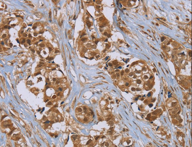 PUS10 Antibody - Immunohistochemistry of paraffin-embedded Human breast cancer using PUS10 Polyclonal Antibody at dilution of 1:45.