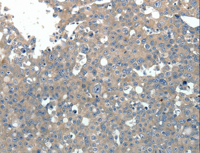 PVALB / Parvalbumin Antibody - Immunohistochemistry of paraffin-embedded Human breast cancer using PVALB Polyclonal Antibody at dilution of 1:20.
