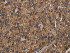 PVRL2 / CD112 Antibody - Immunohistochemistry of paraffin-embedded Human liver cancer using PVRL2 Polyclonal Antibody at dilution of 1:40.