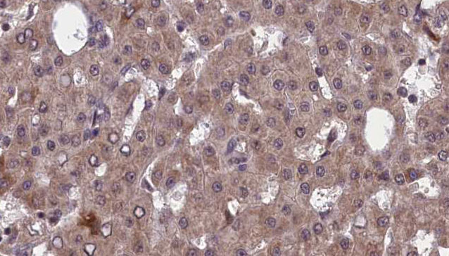 PVRL2 / CD112 Antibody - 1:100 staining human liver carcinoma tissues by IHC-P. The sample was formaldehyde fixed and a heat mediated antigen retrieval step in citrate buffer was performed. The sample was then blocked and incubated with the antibody for 1.5 hours at 22°C. An HRP conjugated goat anti-rabbit antibody was used as the secondary.
