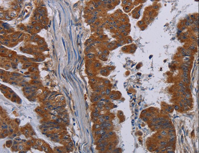 PVRL3 / Nectin-3 Antibody - Immunohistochemistry of paraffin-embedded Human esophagus cancer using PVRL3 Polyclonal Antibody at dilution of 1:40.