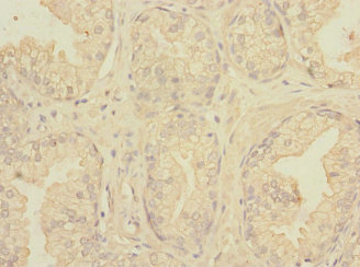 PVRL3 / Nectin-3 Antibody - Immunohistochemistry of paraffin-embedded human prostata cancer at dilution 1:100
