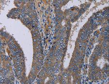 PVRL4 / Nectin 4 Antibody - Immunohistochemistry of paraffin-embedded Human liver cancer using PVRL4 Polyclonal Antibody at dilution of 1:40.