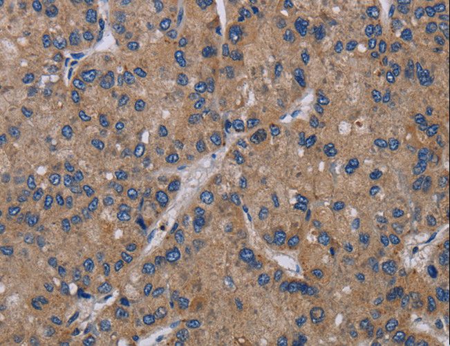 PVRL4 / Nectin 4 Antibody - Immunohistochemistry of paraffin-embedded Human liver cancer using PVRL4 Polyclonal Antibody at dilution of 1:40.
