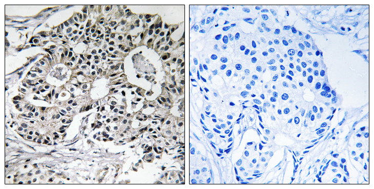PXMP2 Antibody - Immunohistochemistry analysis of paraffin-embedded human breast carcinoma, using PXMP2 Antibody. The picture on the right is blocked with the synthesized peptide.