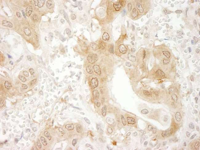 PXN / Paxillin Antibody - Detection of Human Paxillin by Immunohistochemistry. Sample: FFPE section of human non-small cell lung cancer. Antibody: Affinity purified rabbit anti-Paxillin used at a dilution of 1:250.