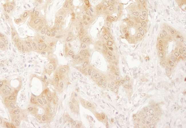 PXN / Paxillin Antibody - Detection of Human Paxillin by Immunohistochemistry. Sample: FFPE section of human non-small cell lung cancer. Antibody: Affinity purified rabbit anti-Paxillin used at a dilution of 1:200 (1 ug/ml). Detection: DAB.