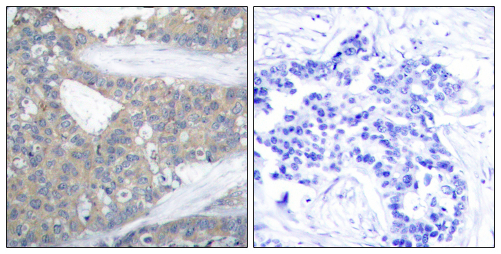 PXN / Paxillin Antibody - Immunohistochemistry analysis of paraffin-embedded human breast carcinoma tissue, using Paxillin Antibody. The picture on the right is blocked with the synthesized peptide.