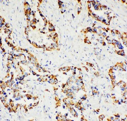PXN / Paxillin Antibody - PXN / Paxillin antibody. IHC(P): Human Lung Cancer Tissue.