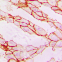 PXN / Paxillin Antibody - Immunohistochemical analysis of Paxillin staining in human breast cancer formalin fixed paraffin embedded tissue section. The section was pre-treated using heat mediated antigen retrieval with sodium citrate buffer (pH 6.0). The section was then incubated with the antibody at room temperature and detected using an HRP conjugated compact polymer system. DAB was used as the chromogen. The section was then counterstained with hematoxylin and mounted with DPX.