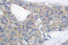 PXN / Paxillin Antibody - IHC of Paxillin (L25) pAb in paraffin-embedded human breast carcinoma tissue.