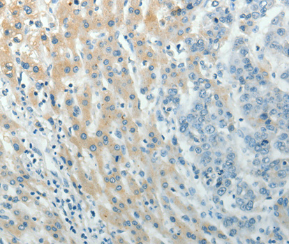 PXN / Paxillin Antibody - Immunohistochemistry of paraffin-embedded human liver cancer tissue.
