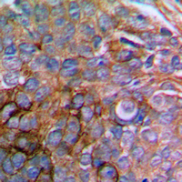PXN / Paxillin Antibody - Immunohistochemical analysis of Paxillin staining in human prostate cancer formalin fixed paraffin embedded tissue section. The section was pre-treated using heat mediated antigen retrieval with sodium citrate buffer (pH 6.0). The section was then incubated with the antibody at room temperature and detected using an HRP-conjugated compact polymer system. DAB was used as the chromogen. The section was then counterstained with hematoxylin and mounted with DPX.