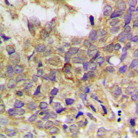 PXN / Paxillin Antibody - Immunohistochemical analysis of Paxillin (pY31) staining in human breast cancer formalin fixed paraffin embedded tissue section. The section was pre-treated using heat mediated antigen retrieval with sodium citrate buffer (pH 6.0). The section was then incubated with the antibody at room temperature and detected using an HRP conjugated compact polymer system. DAB was used as the chromogen. The section was then counterstained with hematoxylin and mounted with DPX.