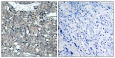 PXN / Paxillin Antibody - Peptide - + Immunohistochemical analysis of paraffin-embedded human breast carcinoma tissue using Paxillin (Ab-118) antibody.