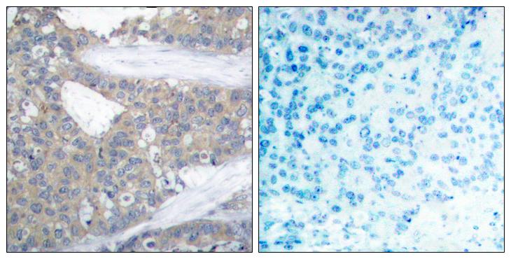 PXN / Paxillin Antibody - Peptide - + Immunohistochemical analysis of paraffin-embedded human breast carcinoma tissue using Paxillin (Ab-31) antibody.