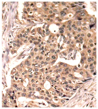 PXN / Paxillin Antibody - Immunohistochemical analysis of paraffin-embedded human breast carcinoma tissue.