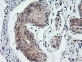 PYCARD / ASC / TMS1 Antibody - IHC of paraffin-embedded Carcinoma of Human pancreas tissue using anti-PYCARD mouse monoclonal antibody. (Heat-induced epitope retrieval by 10mM citric buffer, pH6.0, 100C for 10min).
