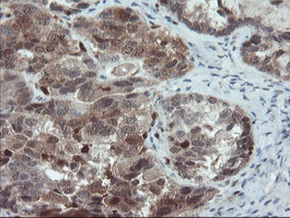 PYCARD / ASC / TMS1 Antibody - IHC of paraffin-embedded Adenocarcinoma of Human ovary tissue using anti-PYCARD mouse monoclonal antibody.